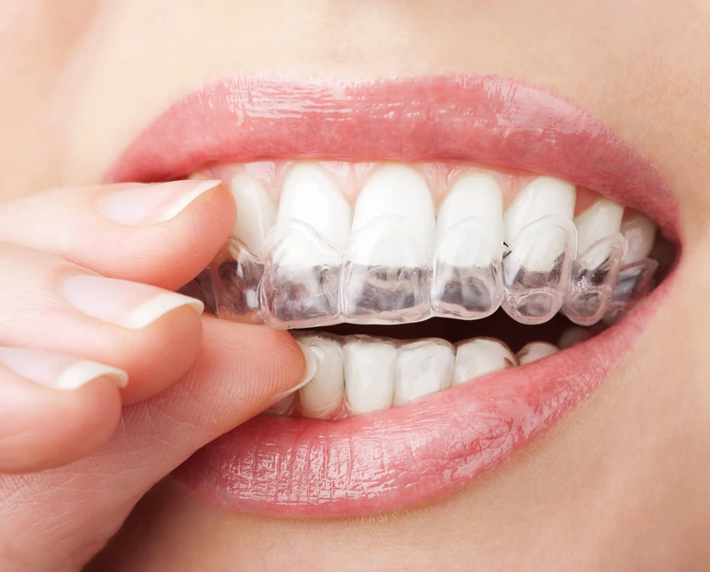 Moldeira de clareamento dental sendo colocada nos dentes