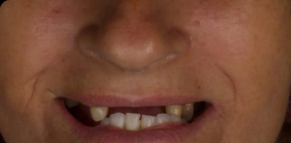 Sorriso antes do tratamento com prótese protocolo – Bittencourt Odontologia, Indaiatuba