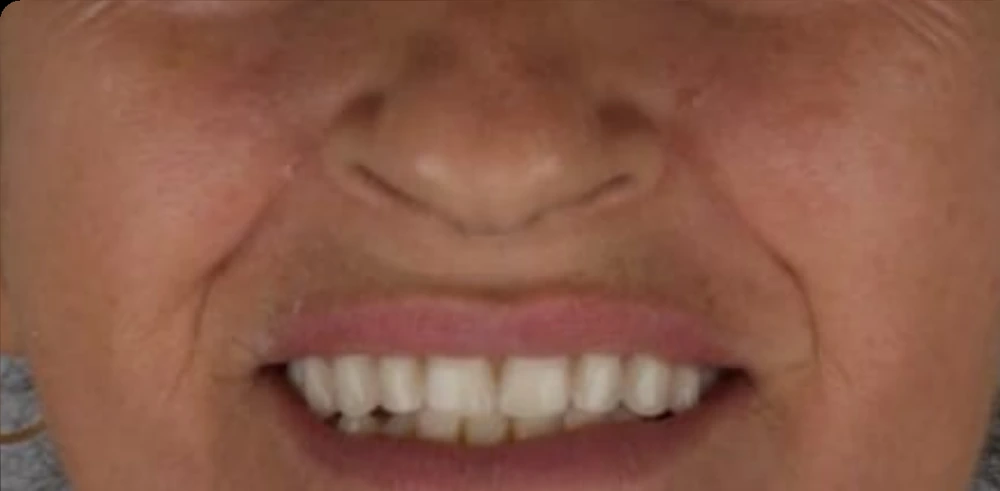 Sorriso reabilitado depois da prótese protocolo – Bittencourt Odontologia, Indaiatuba