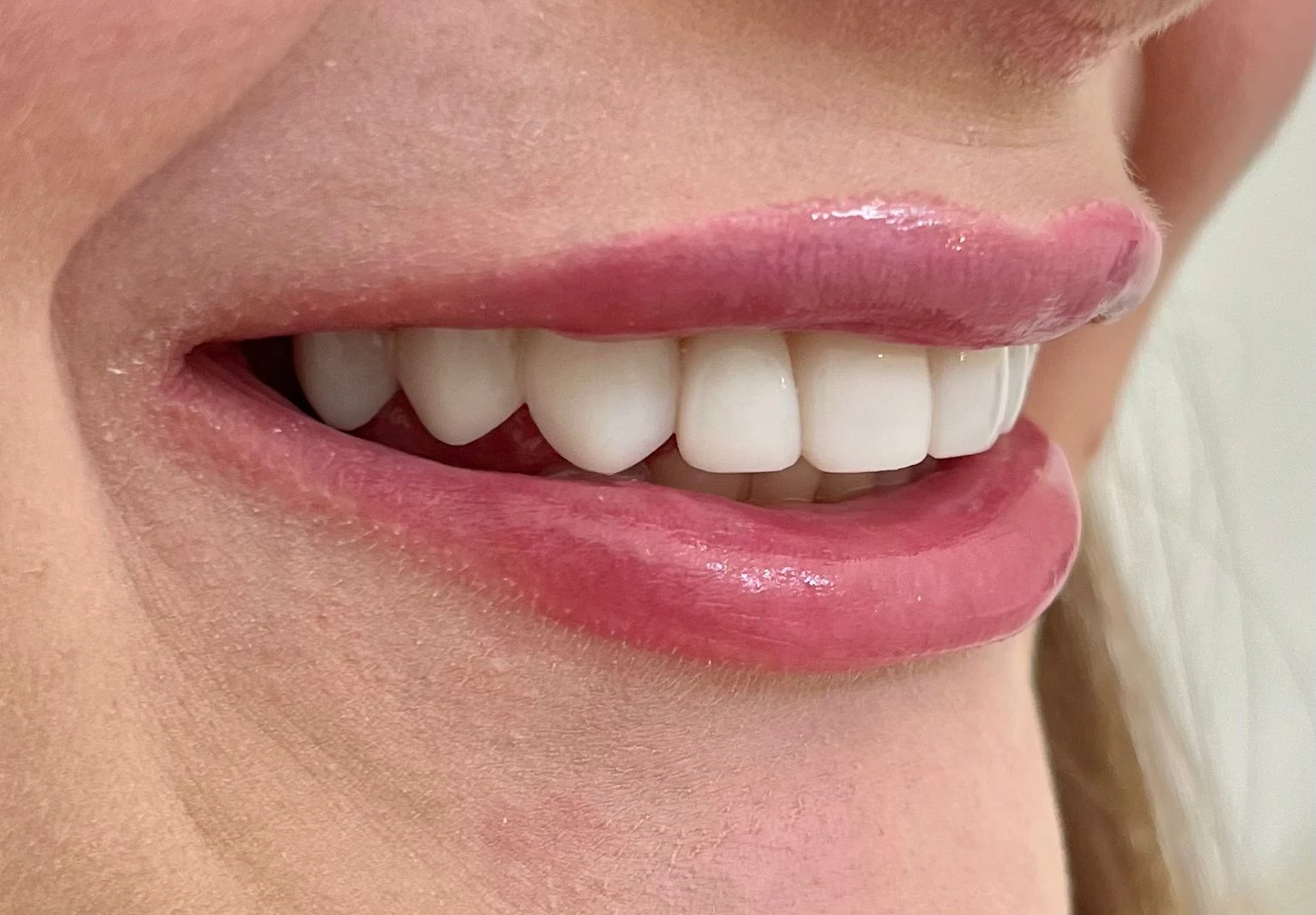 Sorriso com facetas dentárias